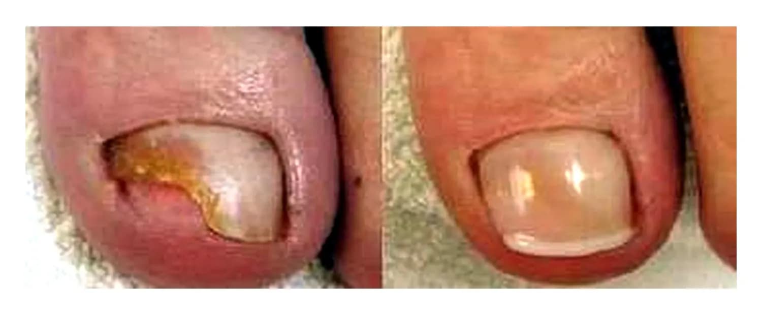 Een beschadigde teennagel voor de behandeling en dezelfde nagel na het herstel met gel